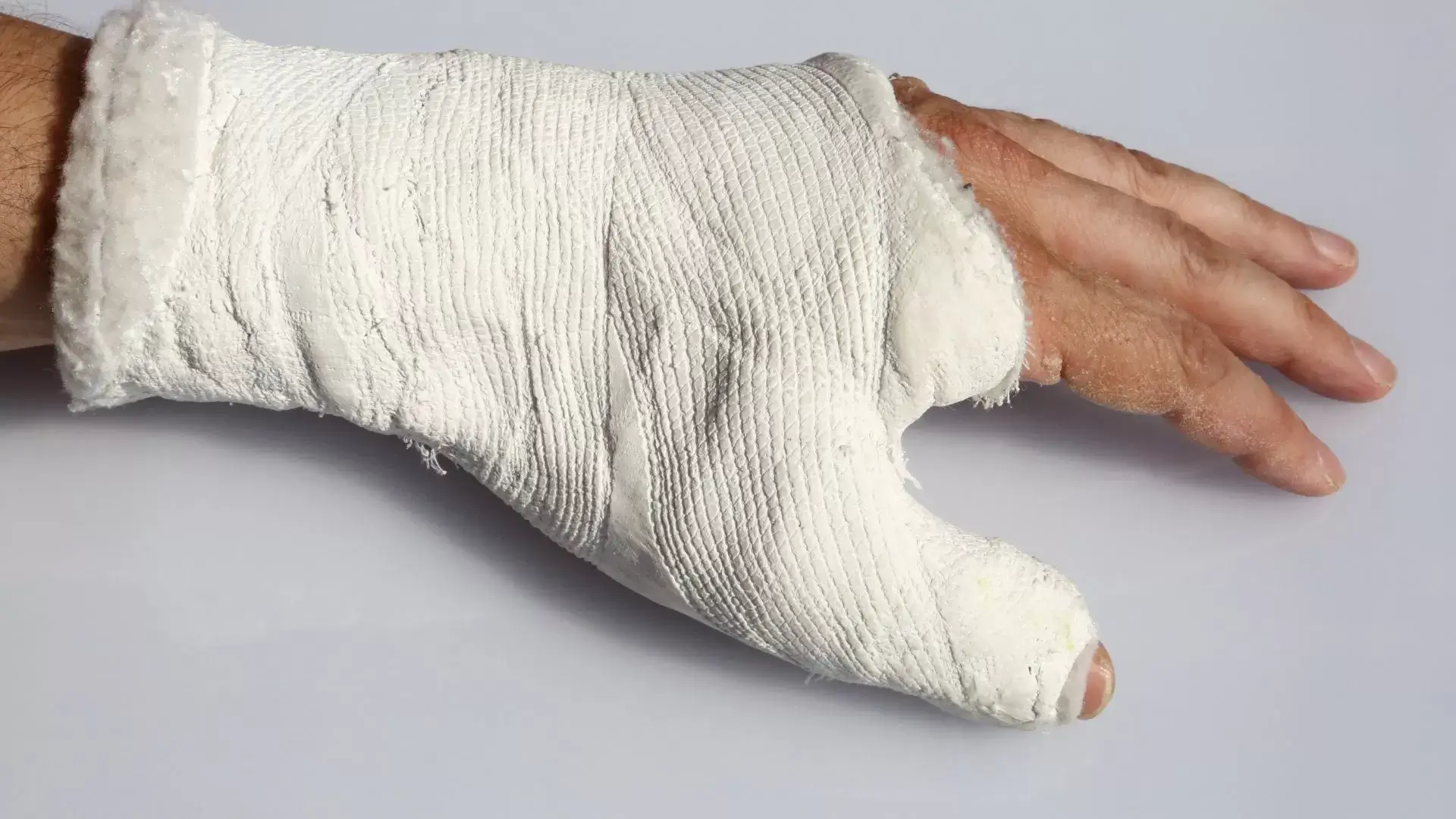 Treating Hand Fractures and Bone Misalignment